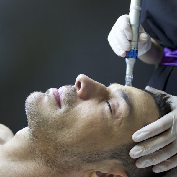 Soin du visage par microneedling BB Glow sur un homme