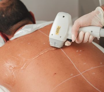 Séance d'épilation laser sur un homme