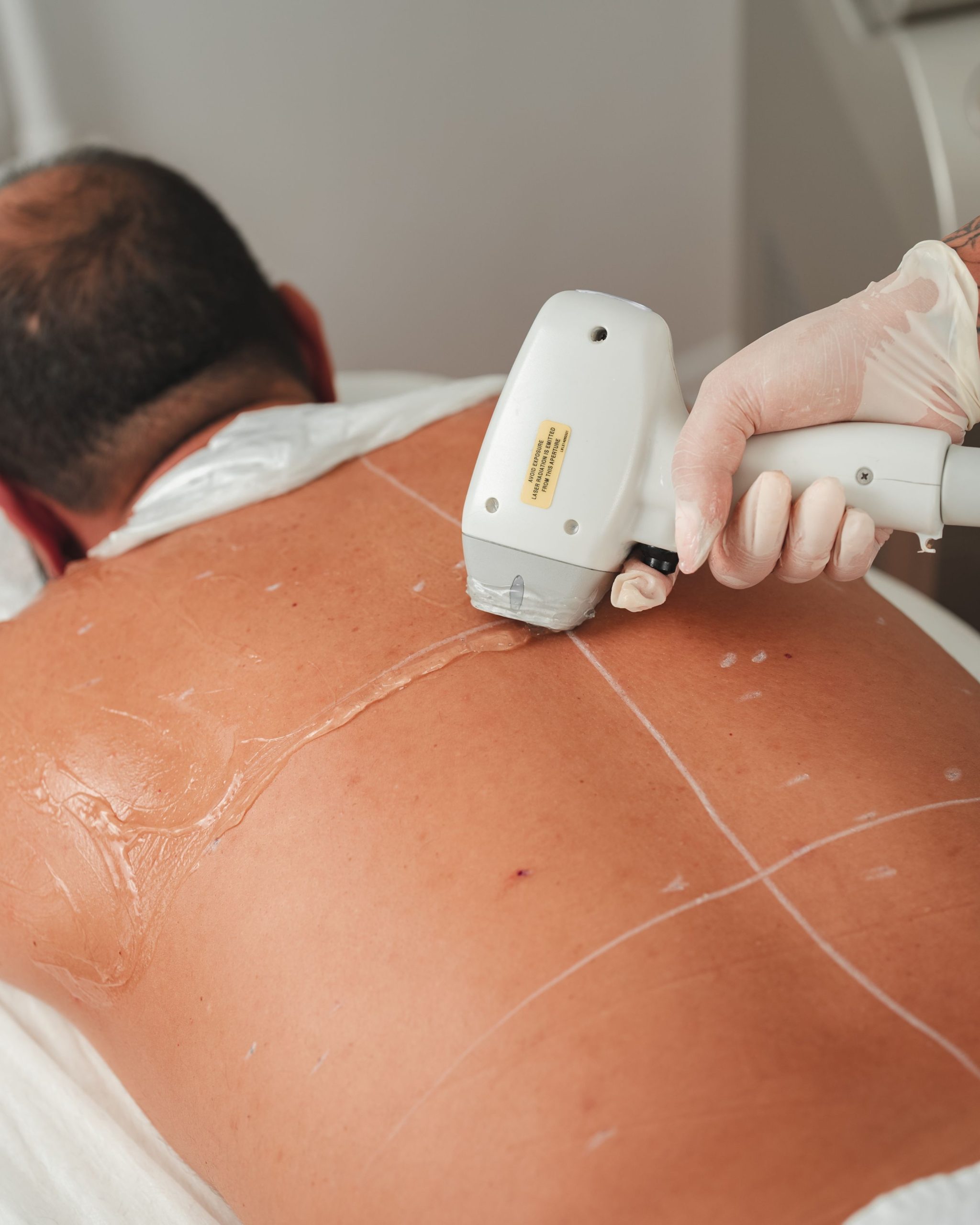 Séance d'épilation laser sur un homme